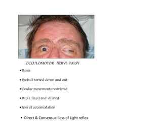 Direct & Consensual loss of Light reflex
 
