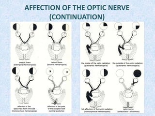 AFFECTION OF THE OPTIC NERVE
(CONTINUATION)
 