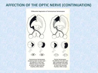 AFFECTION OF THE OPTIC NERVE (CONTINUATION)
 