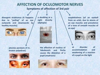 AFFECTION OF OCULOMOTOR NERVES
Symptoms of affection of 3rd pair
divergent strabismus (it happens
due to "pulling" of an eye
outwards and downwards by
healthy muscles)
a doubling at a
sight directly
(diplopia)
exophthalmos (of an eyeball
from an orbit, due to atonia of
an eye muscles and prevalence
of a tone of smooth muscles of
an eye)
ptosis(a paralysis of m.
levator palpebrae)
the affection of nucleus of
Yakubovich and Perlia
causes the dilatation of a
pupil (mydriasis)
at disorder of
accommodation and
weakening of a reaction
of a pupil on the light
 
