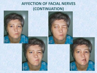 AFFECTION OF FACIAL NERVES
(CONTINUATION)
 