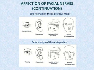 AFFECTION OF FACIAL NERVES
(CONTINUATION)
Before origin of the n. petrosus major
Before origin of the n. stapedius
 
