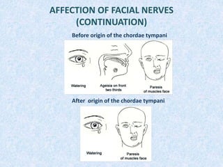 AFFECTION OF FACIAL NERVES
(CONTINUATION)
Before origin of the chordae tympani
After origin of the chordae tympani
 