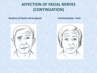 AFFECTION OF FACIAL NERVES
(CONTINUATION)
Nucleus of facial nerve (pons) Corticonuclear tract
 