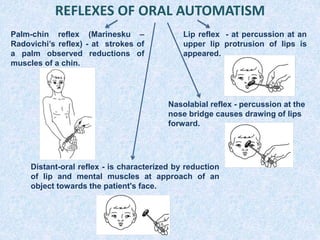 REFLEXES OF ORAL AUTOMATISM
Distant-oral reflex - is characterized by reduction
of lip and mental muscles at approach of an
object towards the patient's face.
Palm-chin reflex (Marinesku –
Radovichi’s reflex) - at strokes of
a palm observed reductions of
muscles of a chin.
Lip reflex - at percussion at an
upper lip protrusion of lips is
appeared.
Nasolabial reflex - percussion at the
nose bridge causes drawing of lips
forward.
 