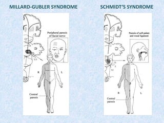 MILLARD-GUBLER SYNDROME SCHMIDT‘S SYNDROME
 