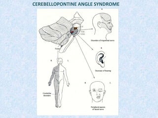 CEREBELLOPONTINE ANGLE SYNDROME
 