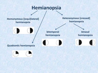 Hemianopsia
Homonymous [(equi)lateral]
hemianopsia
Heteronymous [crossed]
hemianopsia
bitemporal
hemianopsia
binasal
hemianopsia
Quadrantic hemianopsia
 