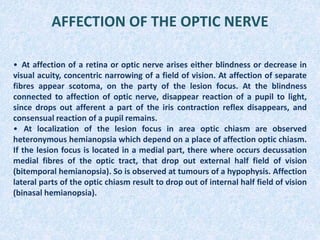 AFFECTION OF THE OPTIC NERVE
• At affection of a retina or optic nerve arises either blindness or decrease in
visual acuity, concentric narrowing of a field of vision. At affection of separate
fibres appear scotoma, on the party of the lesion focus. At the blindness
connected to affection of optic nerve, disappear reaction of a pupil to light,
since drops out afferent a part of the iris contraction reflex disappears, and
consensual reaction of a pupil remains.
• At localization of the lesion focus in area optic chiasm are observed
heteronymous hemianopsia which depend on a place of affection optic chiasm.
If the lesion focus is located in a medial part, there where occurs decussation
medial fibres of the optic tract, that drop out external half field of vision
(bitemporal hemianopsia). So is observed at tumours of a hypophysis. Affection
lateral parts of the optic chiasm result to drop out of internal half field of vision
(binasal hemianopsia).
 