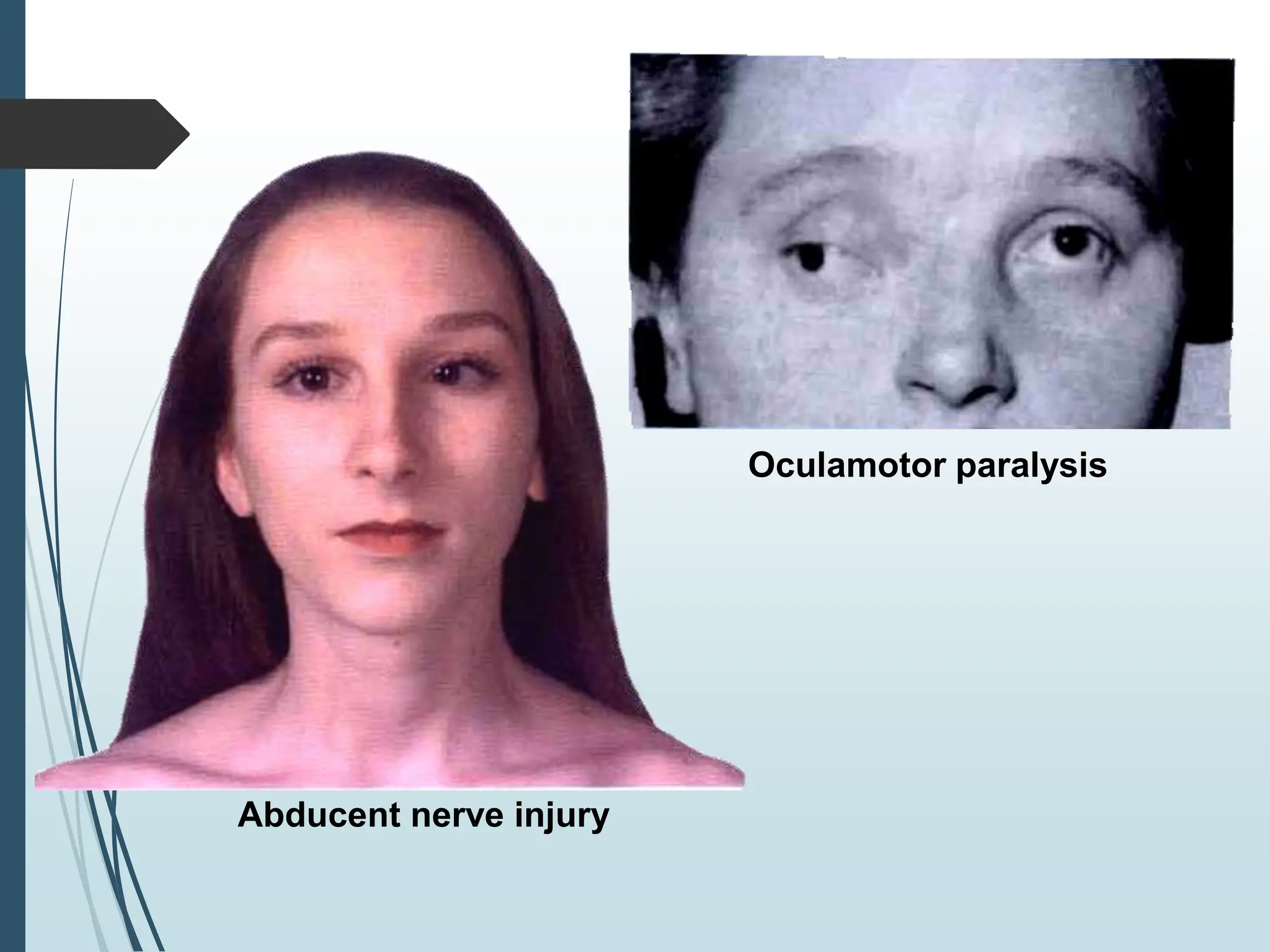 Oculamotor paralysis
Abducent nerve injury
 