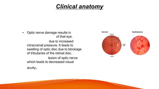 Clinical anatomy
• Optic nerve damage results in
complete blindness of that eye.
• Papilloedema: due to increased
intracranial pressure. It leads to
swelling of optic disc due to blockage
of tributaries of the retinal disc.
• Optic neuritis: lesion of optic nerve
which leads to decreased visual
acuity.
 