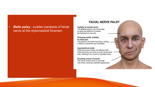• Bells palsy : sudden paralysis of facial
nerve at the stylomastoid foramen.
 
