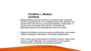 Prosthodontic consideration
• Moebius/Mӧbius Syndrome (MS) is an extremely rare congenital
disorder characterized by uni- or bilateral palsy of the abducens (VI)
and the facial (VII) nerves, causing facial paralysis. Dysfunction of
cranial nerves III through XII is common, most often the
glossopharyngeal (IX) and hypoglossus (XII) are involved.
• Patients with Moebius syndrome seeking prosthodontic care present
multiple challenges, particularly in removable prosthodontics.
• This is mainly due to the paralysis of all facial muscles. Small mouth
opening, speech difficulties, and compromised neuromuscular
control present a challenge to successful restoration.
Condition 1 : Moebius
syndrome
 