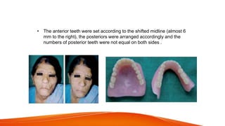 • The anterior teeth were set according to the shifted midline (almost 6
mm to the right), the posteriors were arranged accordingly and the
numbers of posterior teeth were not equal on both sides .
 