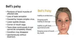 Bell’s palsy
• Paralysis of facial muscles of
affected side
• Loss of taste sensation
• Caused by herpes simplex virus.
• Lower eyelids droops.
• Corner of mouth sags.
• Tears drips continuously & eye
cannot be completely closed.
• Condition may disappear
• spontaneously without
treatment.
 