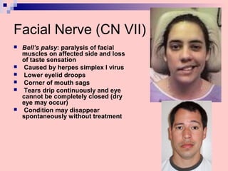 Facial Nerve (CN VII)
 Bell’s palsy: paralysis of facial
muscles on affected side and loss
of taste sensation
 Caused by herpes simplex I virus
 Lower eyelid droops
 Corner of mouth sags
 Tears drip continuously and eye
cannot be completely closed (dry
eye may occur)
 Condition may disappear
spontaneously without treatment
 