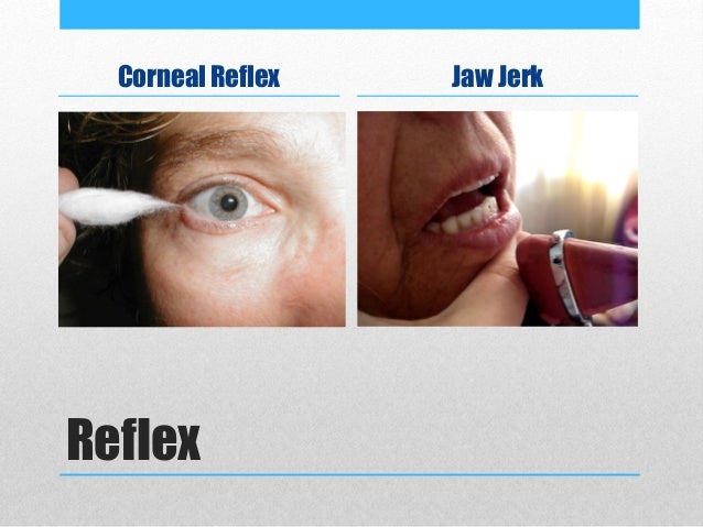 Jaw Jerk Reflex Bulbar Palsy