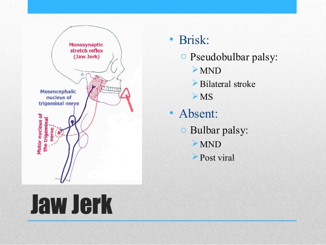 Jaw Jerk Reflex Bulbar Palsy