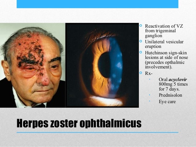 Herpes Zoster Ophthalmicus Cranial Nerve 7 — Herpes Free Me