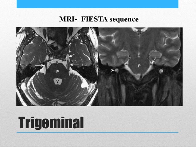 Diseases of Cranial nerves 5th, 7th and 8th
