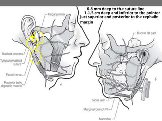 1-1.5 cm deep and inferior to the pointer
6-8 mm deep to the suture line
just superior and posterior to the cephalic
margin
 