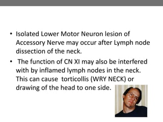 • Isolated Lower Motor Neuron lesion of
Accessory Nerve may occur after Lymph node
dissection of the neck.
• The function of CN XI may also be interfered
with by inflamed lymph nodes in the neck.
This can cause torticollis (WRY NECK) or
drawing of the head to one side.
 