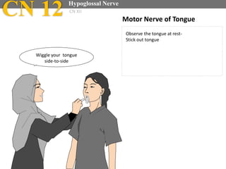 CN 12 Hypoglossal Nerve
CN XII
Motor Nerve of Tongue
Observe the tongue at rest-
Stick out tongue
Wiggle your tongue
side-to-side
 