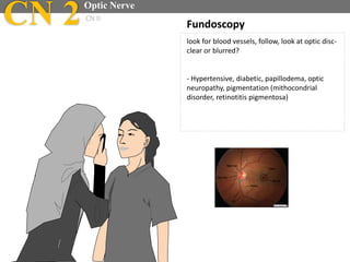 Fundoscopy
look for blood vessels, follow, look at optic disc-
clear or blurred?
- Hypertensive, diabetic, papillodema, optic
neuropathy, pigmentation (mithocondrial
disorder, retinotitis pigmentosa)
CN 2Optic Nerve
CN II
 