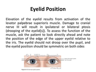 Eyelid Position
Elevation of the eyelid results from activation of the
levator palpebrae superioris muscle. Damage to cranial
nerve III will result in ipsilateral or bilateral ptosis
(drooping of the eyelid[s]). To assess the function of the
muscle, ask the patient to look directly ahead and note
the position of the edge of the upper eyelid relative to
the iris. The eyelid should not droop over the pupil, and
the eyelid position should be symmetric on both sides
 