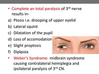 • Complete an total paralysis of 3rd nerve
results in-
a) Ptosis i.e. drooping of upper eyelid
b) Lateral squint
c) Dilatation of the pupil
d) Loss of accomodation
e) Slight proptosis
f) Diplpoia
• Weber’s Syndrome- midbrain syndrome
causing contralateral hemiplegia and
ipsilateral paralysis of 3rd CN.
 