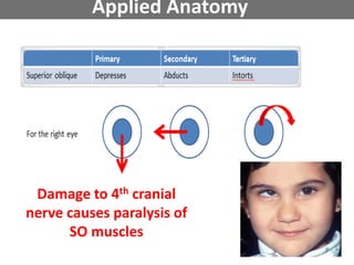 Applied Anatomy
Damage to 4th cranial
nerve causes paralysis of
SO muscles
 