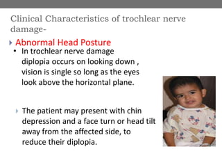  Abnormal Head Posture
 The patient may present with chin
depression and a face turn or head tilt
away from the affected side, to
reduce their diplopia.
Clinical Characteristics of trochlear nerve
damage-
• In trochlear nerve damage
diplopia occurs on looking down ,
vision is single so long as the eyes
look above the horizontal plane.
 