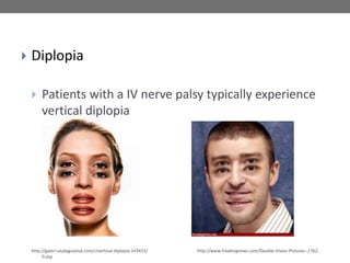  Diplopia
 Patients with a IV nerve palsy typically experience
vertical diplopia
http://galeri.uludagsozluk.com/r/vertical-diplopia-143415/ http://www.freakingnews.com/Double-Vision-Pictures--1762-
0.asp
 