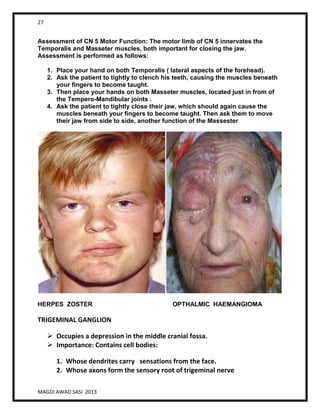 27
MAGDI AWAD SASI 2013
Assessment of CN 5 Motor Function: The motor limb of CN 5 innervates the
Temporalis and Masseter muscles, both important for closing the jaw.
Assessment is performed as follows:
1. Place your hand on both Temporalis ( lateral aspects of the forehead).
2. Ask the patient to tightly to clench his teeth, causing the muscles beneath
your fingers to become taught.
3. Then place your hands on both Masseter muscles, located just in from of
the Tempero-Mandibular joints .
4. Ask the patient to tightly close their jaw, which should again cause the
muscles beneath your fingers to become taught. Then ask them to move
their jaw from side to side, another function of the Massester
HERPES ZOSTER OPTHALMIC HAEMANGIOMA
TRIGEMINAL GANGLION
 Occupies a depression in the middle cranial fossa.
 Importance: Contains cell bodies:
1. Whose dendrites carry sensations from the face.
2. Whose axons form the sensory root of trigeminal nerve
 