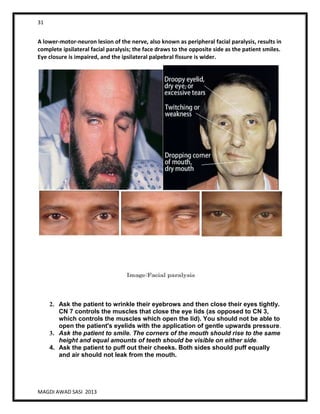31
MAGDI AWAD SASI 2013
A lower-motor-neuron lesion of the nerve, also known as peripheral facial paralysis, results in
complete ipsilateral facial paralysis; the face draws to the opposite side as the patient smiles.
Eye closure is impaired, and the ipsilateral palpebral fissure is wider.
2. Ask the patient to wrinkle their eyebrows and then close their eyes tightly.
CN 7 controls the muscles that close the eye lids (as opposed to CN 3,
which controls the muscles which open the lid). You should not be able to
open the patient's eyelids with the application of gentle upwards pressure.
3. Ask the patient to smile. The corners of the mouth should rise to the same
height and equal amounts of teeth should be visible on either side.
4. Ask the patient to puff out their cheeks. Both sides should puff equally
and air should not leak from the mouth.
 