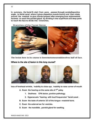 32
MAGDI AWAD SASI 2013
In summary , the facial N. start from pons , passes through cerebellopontine
angle , to facial canal where it gives stapedius muscle branch and then rotate
around the mastoid to give chorda tympani after emerging from stylomastoid
foramen to reach the parotid gland by dividing it into superficial and deep parts
to reach the face to divide into 5 branches.
The lesion here in its course is lowermotorneuron&involves half of face.
Where is the site of lesion in this long course?
loss of forehead wrinkle, inability to close eye, inability to raise corner of mouth
A. Exam the hearing on the same site of 7th
palsy
1. Deafness CPA lesion, pontine pathology.
2. Hyperacusis “hearing with loud frequencies” facial canal .
B. Exam the taste of anterior 2/3 of the tongue –mastoid bone.
C. Exam the external ear for vesicles.
D. Exam the mandible , parotid gland for swelling.
 