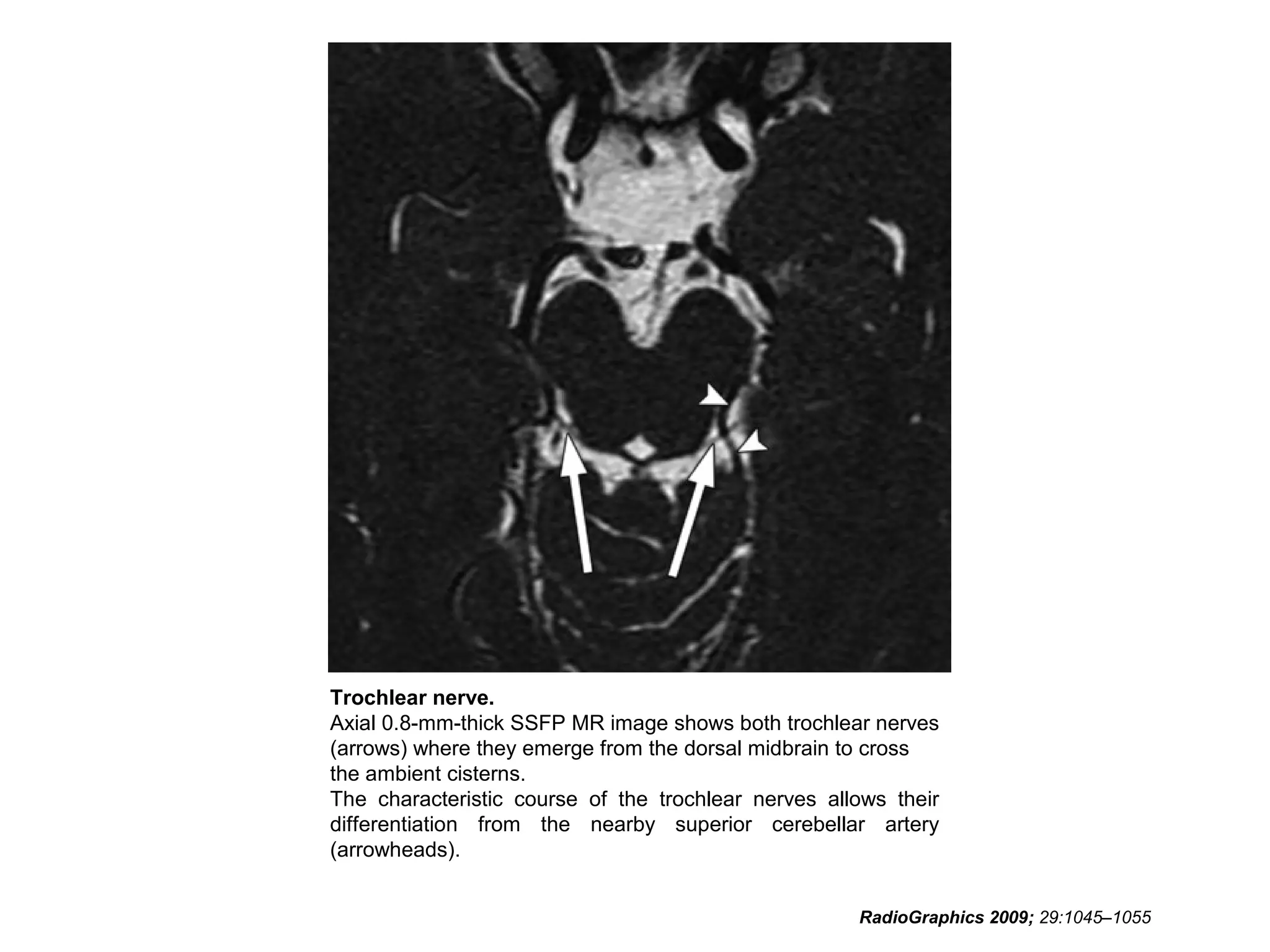 Trochlear nerve.
Axial 0.8-mm-thick SSFP MR image shows both trochlear nerves
(arrows) where they emerge from the dorsal midbrain to cross
the ambient cisterns.
The characteristic course of the trochlear nerves allows their
differentiation from the nearby superior cerebellar artery
(arrowheads).
RadioGraphics 2009; 29:1045–1055
 