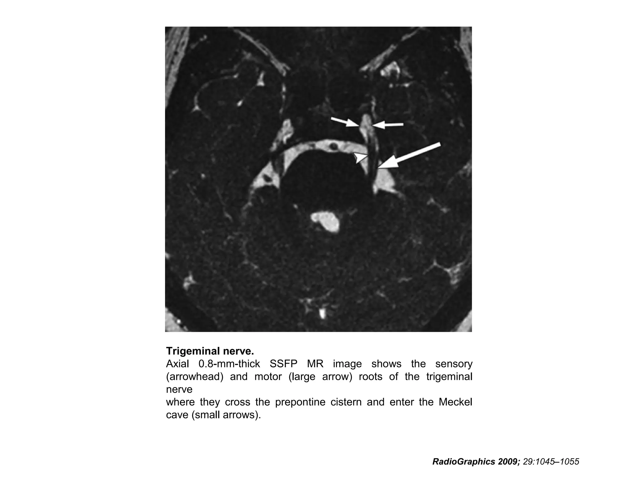 Trigeminal nerve.
Axial 0.8-mm-thick SSFP MR image shows the sensory
(arrowhead) and motor (large arrow) roots of the trigeminal
nerve
where they cross the prepontine cistern and enter the Meckel
cave (small arrows).
RadioGraphics 2009; 29:1045–1055
 