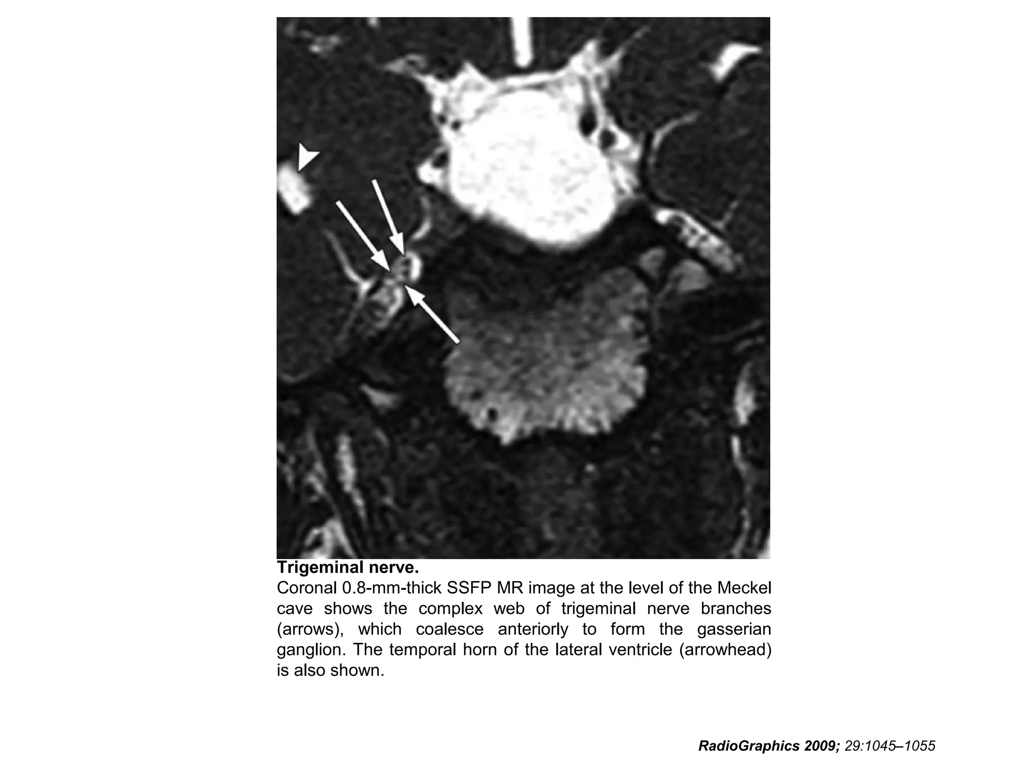 Trigeminal nerve.
Coronal 0.8-mm-thick SSFP MR image at the level of the Meckel
cave shows the complex web of trigeminal nerve branches
(arrows), which coalesce anteriorly to form the gasserian
ganglion. The temporal horn of the lateral ventricle (arrowhead)
is also shown.
RadioGraphics 2009; 29:1045–1055
 
