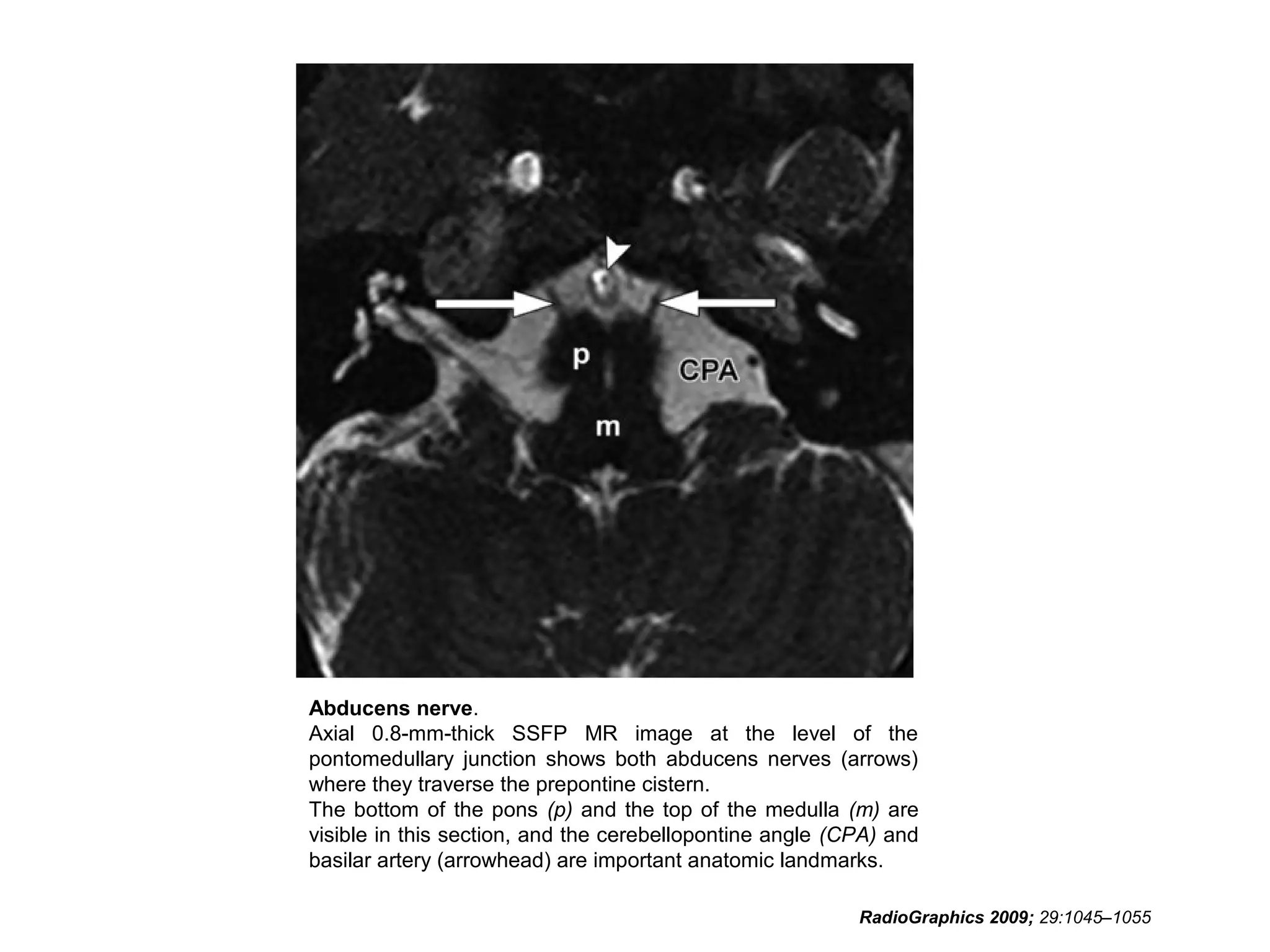 Abducens nerve.
Axial 0.8-mm-thick SSFP MR image at the level of the
pontomedullary junction shows both abducens nerves (arrows)
where they traverse the prepontine cistern.
The bottom of the pons (p) and the top of the medulla (m) are
visible in this section, and the cerebellopontine angle (CPA) and
basilar artery (arrowhead) are important anatomic landmarks.
RadioGraphics 2009; 29:1045–1055
 