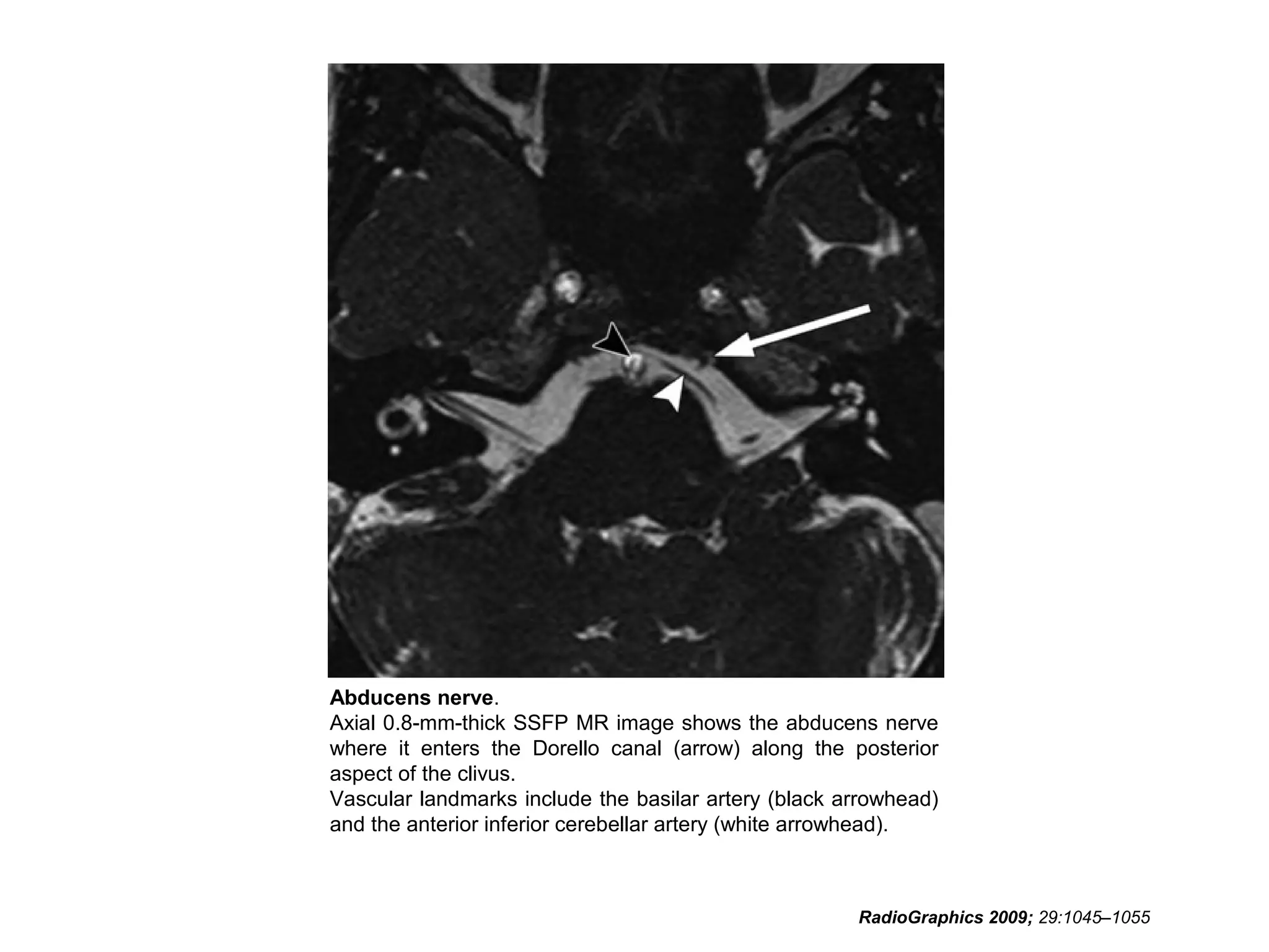 Abducens nerve.
Axial 0.8-mm-thick SSFP MR image shows the abducens nerve
where it enters the Dorello canal (arrow) along the posterior
aspect of the clivus.
Vascular landmarks include the basilar artery (black arrowhead)
and the anterior inferior cerebellar artery (white arrowhead).
RadioGraphics 2009; 29:1045–1055
 