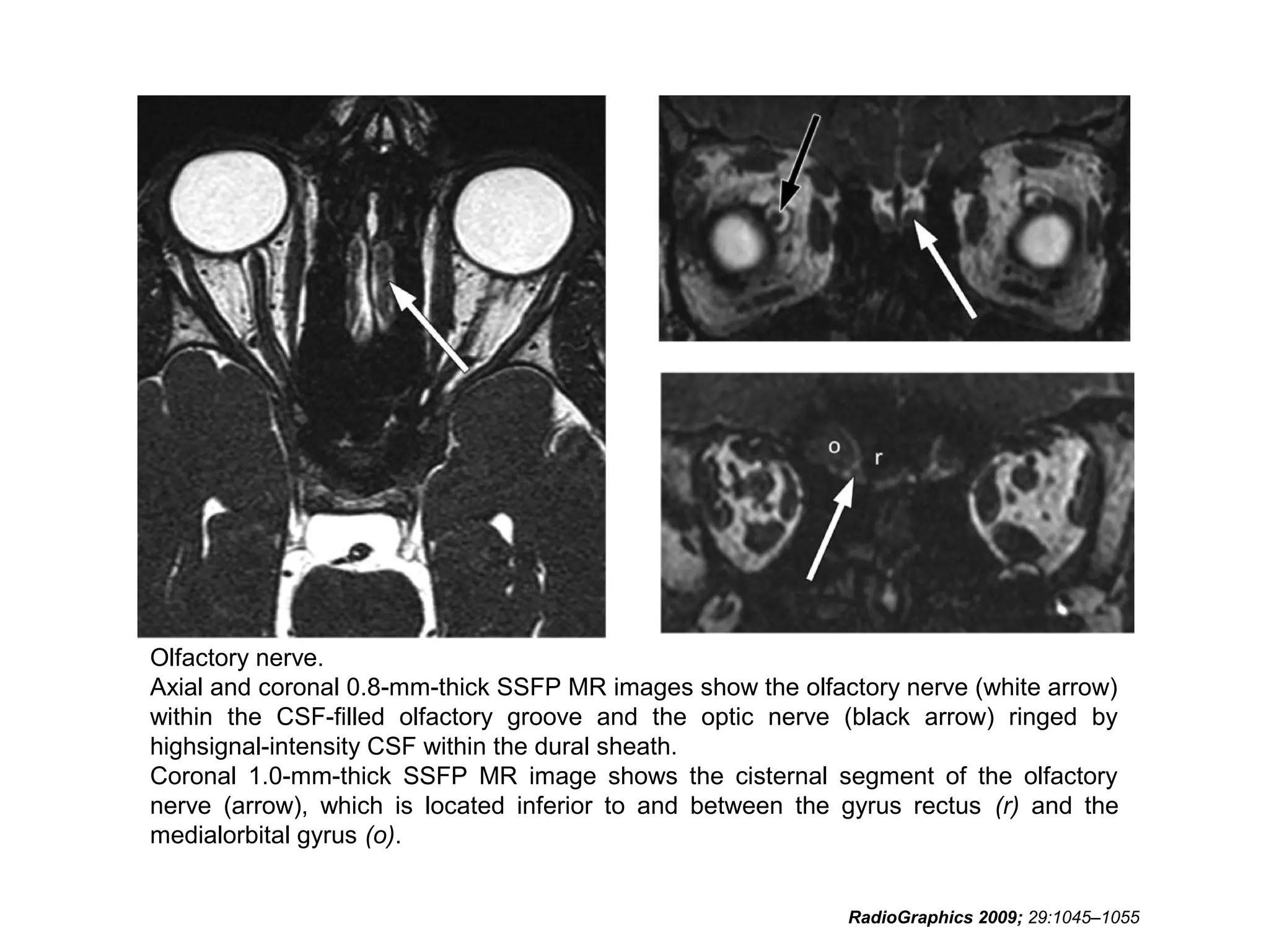 Olfactory nerve.
Axial and coronal 0.8-mm-thick SSFP MR images show the olfactory nerve (white arrow)
within the CSF-filled olfactory groove and the optic nerve (black arrow) ringed by
highsignal-intensity CSF within the dural sheath.
Coronal 1.0-mm-thick SSFP MR image shows the cisternal segment of the olfactory
nerve (arrow), which is located inferior to and between the gyrus rectus (r) and the
medialorbital gyrus (o).
RadioGraphics 2009; 29:1045–1055
 