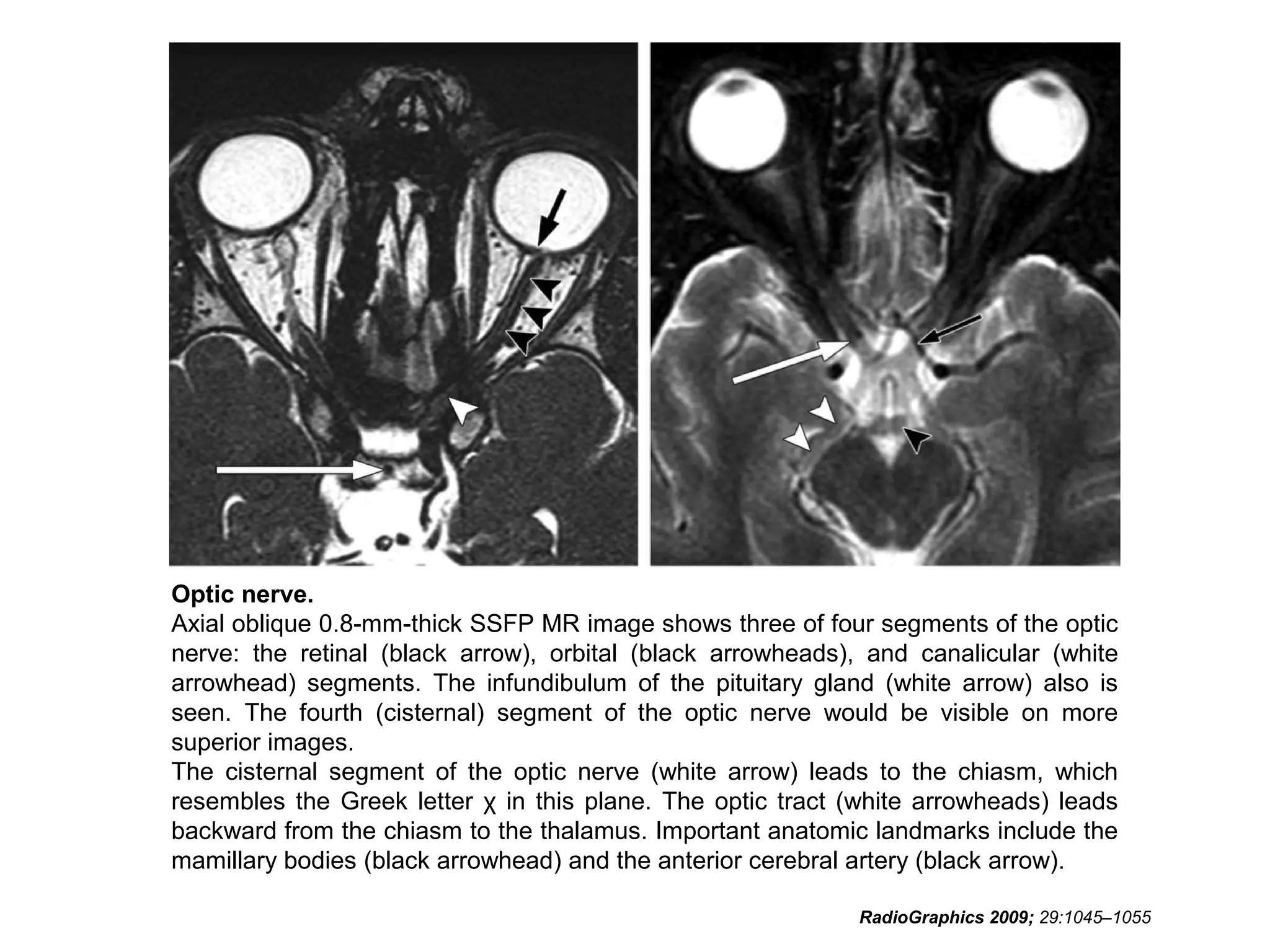 Optic nerve.
Axial oblique 0.8-mm-thick SSFP MR image shows three of four segments of the optic
nerve: the retinal (black arrow), orbital (black arrowheads), and canalicular (white
arrowhead) segments. The infundibulum of the pituitary gland (white arrow) also is
seen. The fourth (cisternal) segment of the optic nerve would be visible on more
superior images.
The cisternal segment of the optic nerve (white arrow) leads to the chiasm, which
resembles the Greek letter χ in this plane. The optic tract (white arrowheads) leads
backward from the chiasm to the thalamus. Important anatomic landmarks include the
mamillary bodies (black arrowhead) and the anterior cerebral artery (black arrow).
RadioGraphics 2009; 29:1045–1055
 