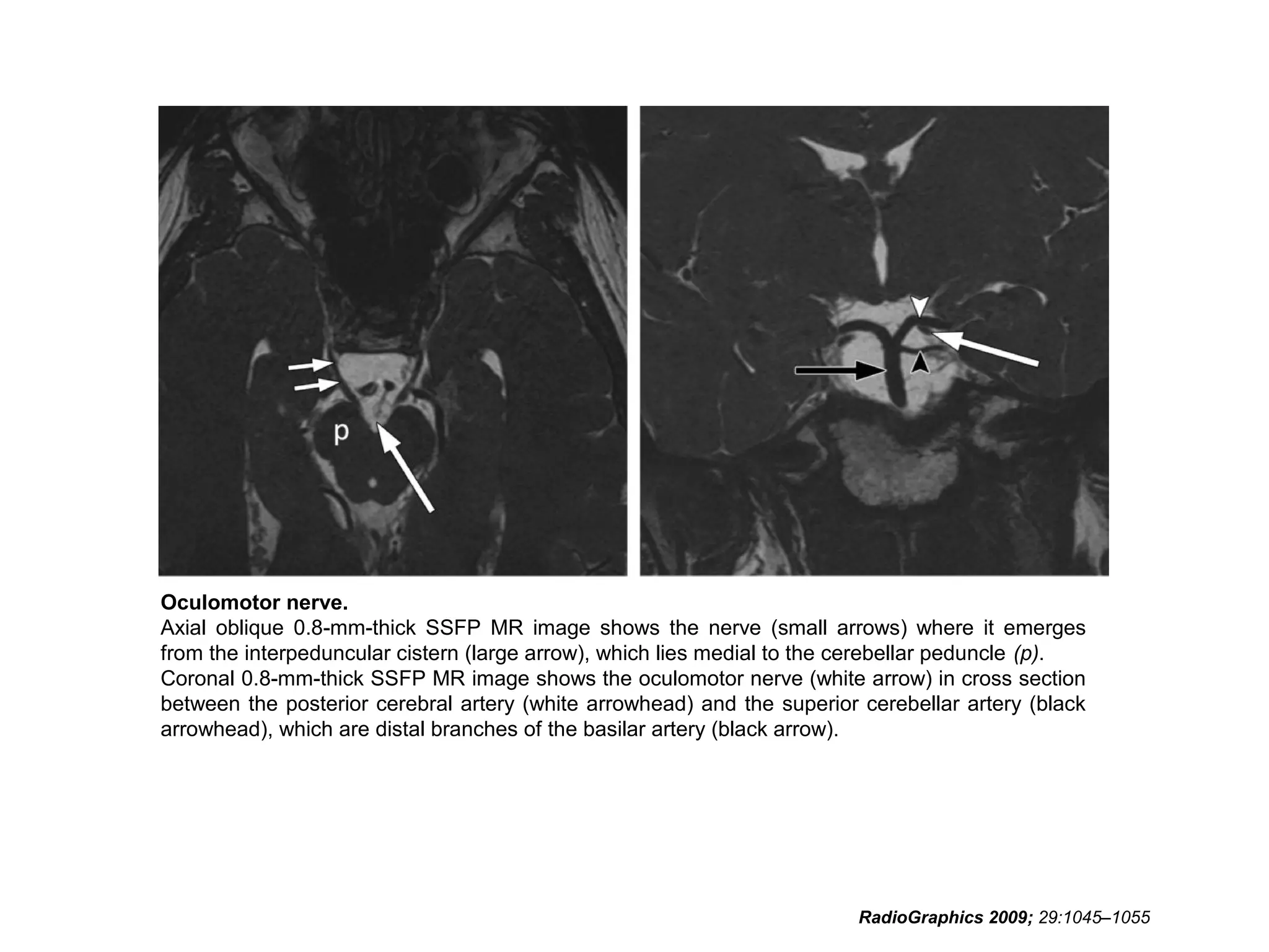 Oculomotor nerve.
Axial oblique 0.8-mm-thick SSFP MR image shows the nerve (small arrows) where it emerges
from the interpeduncular cistern (large arrow), which lies medial to the cerebellar peduncle (p).
Coronal 0.8-mm-thick SSFP MR image shows the oculomotor nerve (white arrow) in cross section
between the posterior cerebral artery (white arrowhead) and the superior cerebellar artery (black
arrowhead), which are distal branches of the basilar artery (black arrow).
RadioGraphics 2009; 29:1045–1055
 