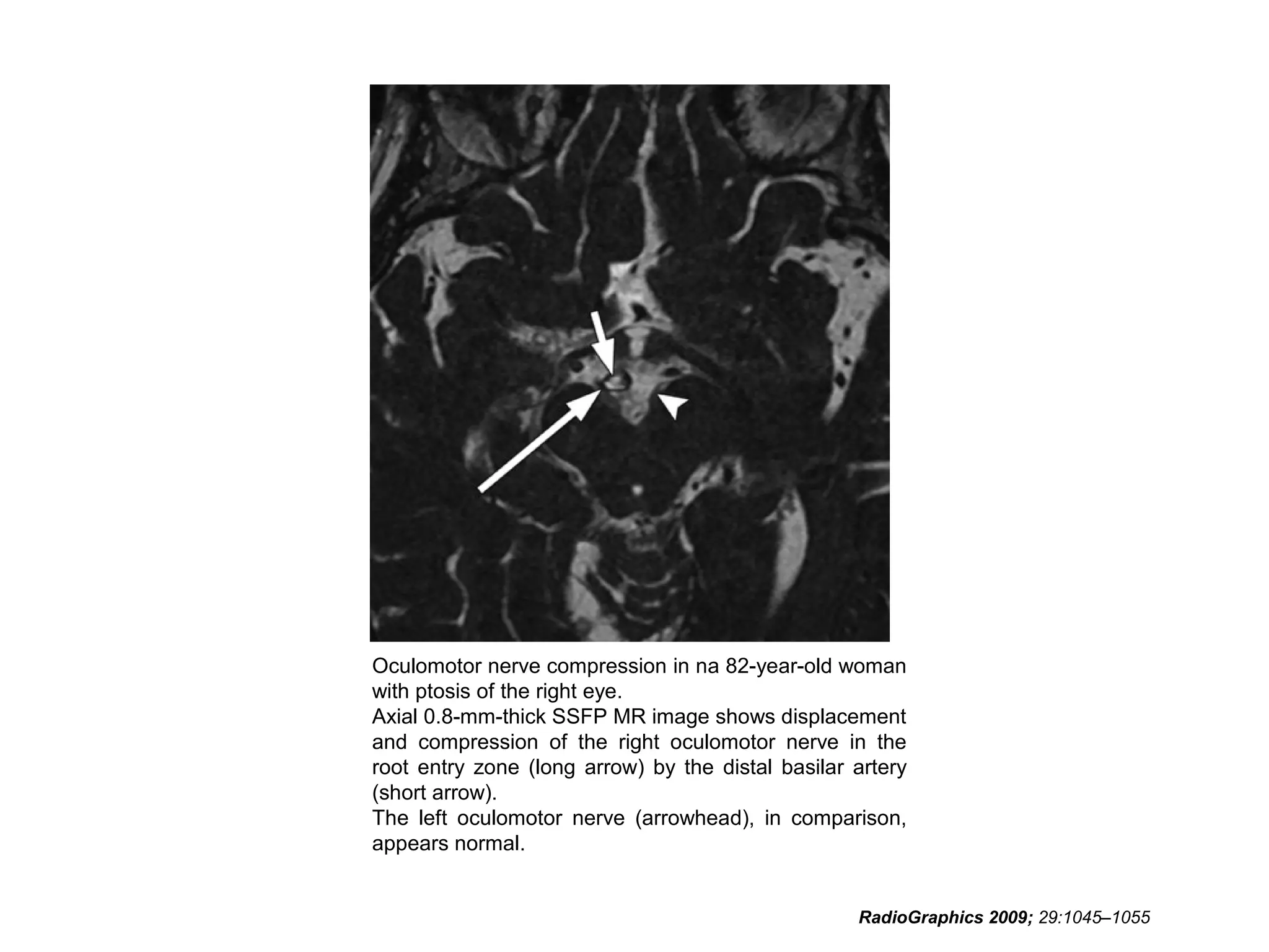 Oculomotor nerve compression in na 82-year-old woman
with ptosis of the right eye.
Axial 0.8-mm-thick SSFP MR image shows displacement
and compression of the right oculomotor nerve in the
root entry zone (long arrow) by the distal basilar artery
(short arrow).
The left oculomotor nerve (arrowhead), in comparison,
appears normal.
RadioGraphics 2009; 29:1045–1055
 