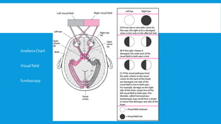 Snellens Chart
Visual field
fundoscopy
 
