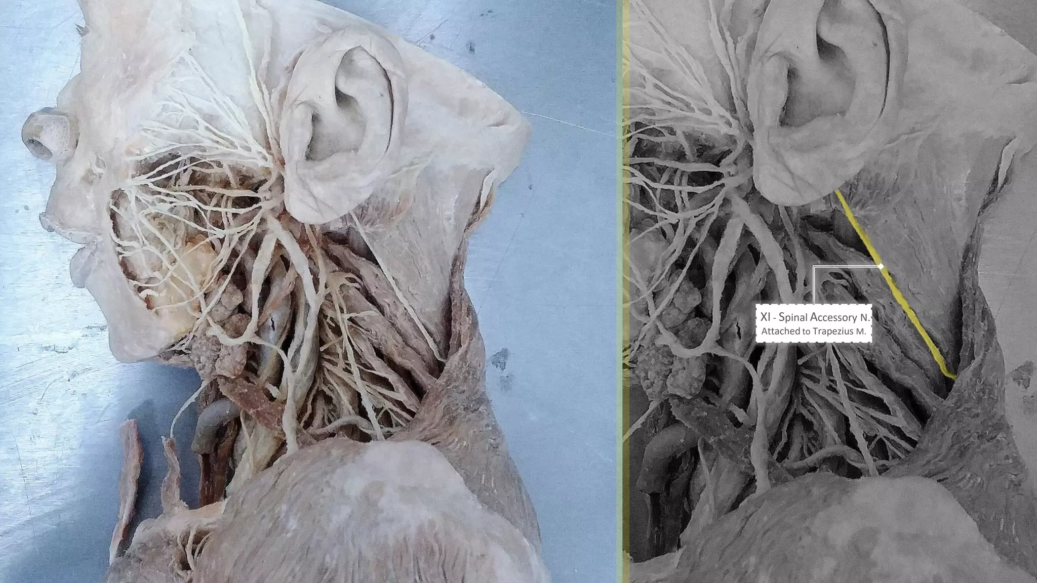 XI - Spinal Accessory N.
Attached to Trapezius M.
 