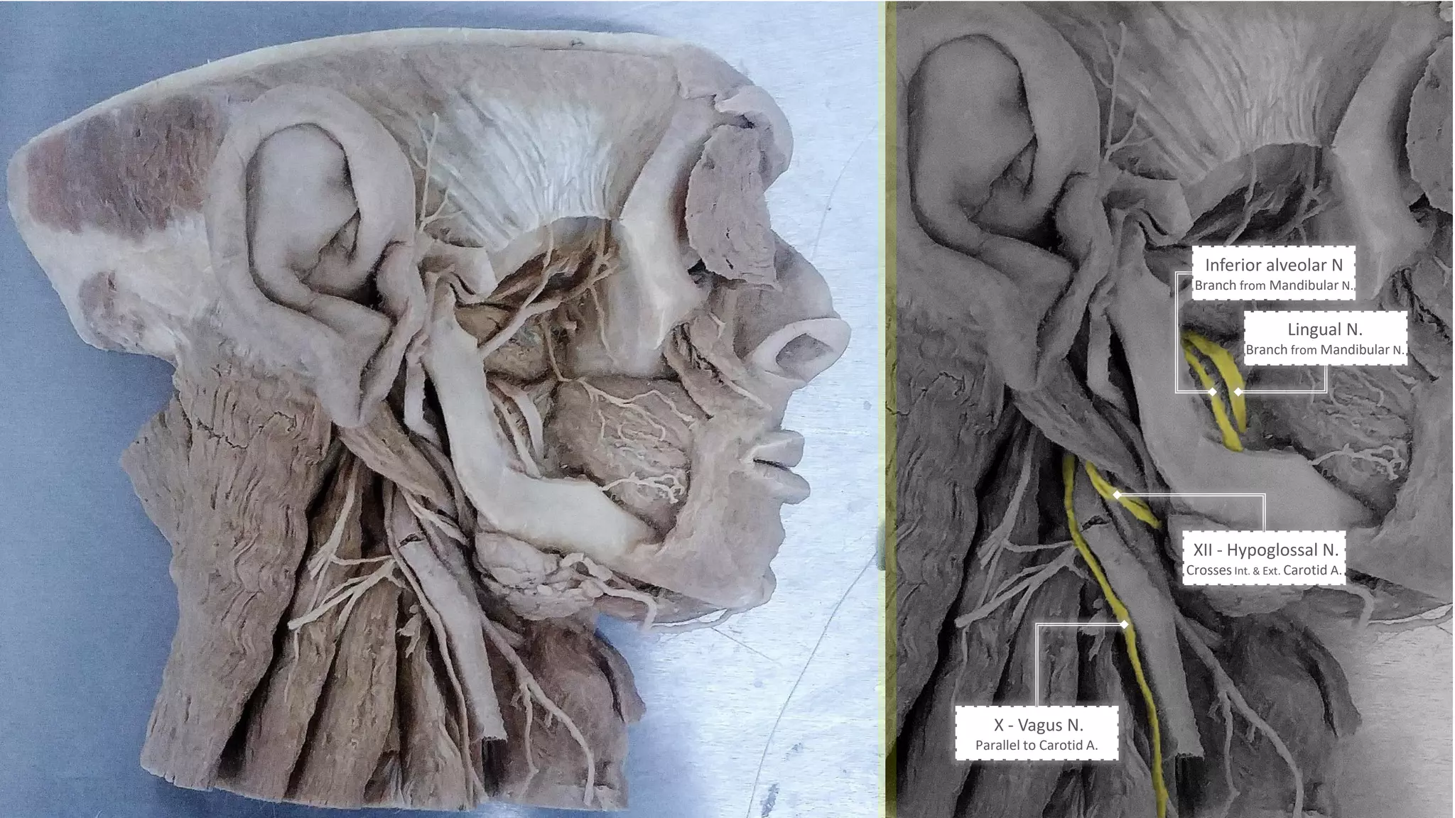 Lingual N.
Branch from Mandibular N.
X - Vagus N.
Parallel to Carotid A.
XII - Hypoglossal N.
Crosses Int. & Ext. Carotid A.
Inferior alveolar N
Branch from Mandibular N.
 