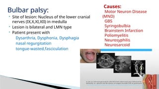 Bulbar Dysfunction Examination of lower cranial nervesCRANIAL NERVES (XI,XII) | PPTX