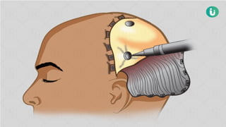 Cranial surgery.It's techniques intervention pptx | PPTX